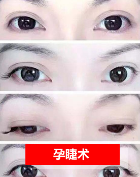 孕睫术
